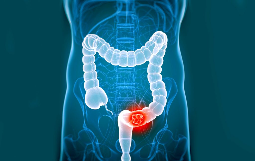 What Are The Three Types Of Colorectal Cancer