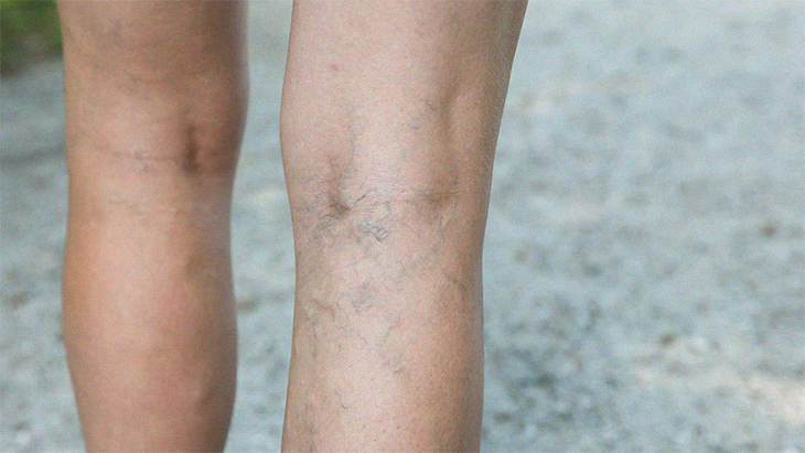 Signs And Symptoms Of Blood Clot In Your Legs
