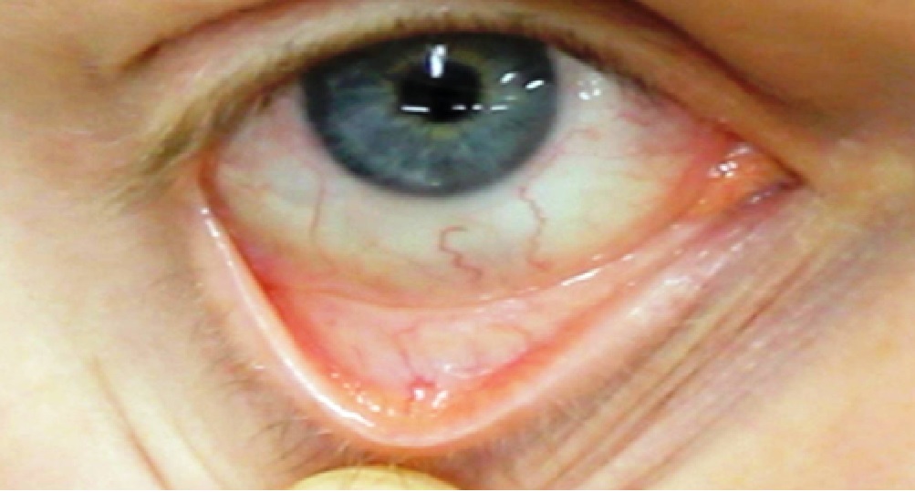 13 Common Symptoms and Signs of Iron Deficiency • Page 2 of 14